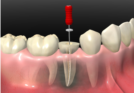 歯根嚢胞摘出  歯根端切除